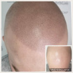 ScalpMicropigmentationBlog LagunaMedSpa