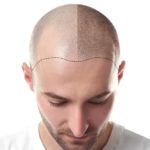 Scalp Micropigmentation