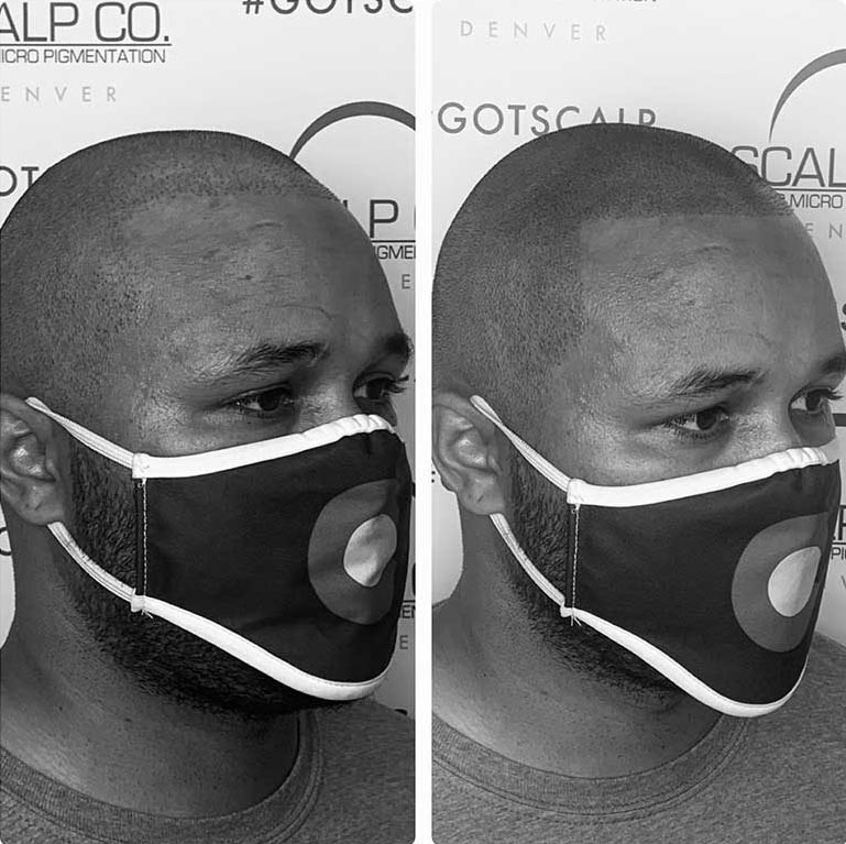 What Is Scalp Micropigmentation?