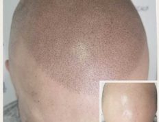 What Is Scalp Micropigmentation?