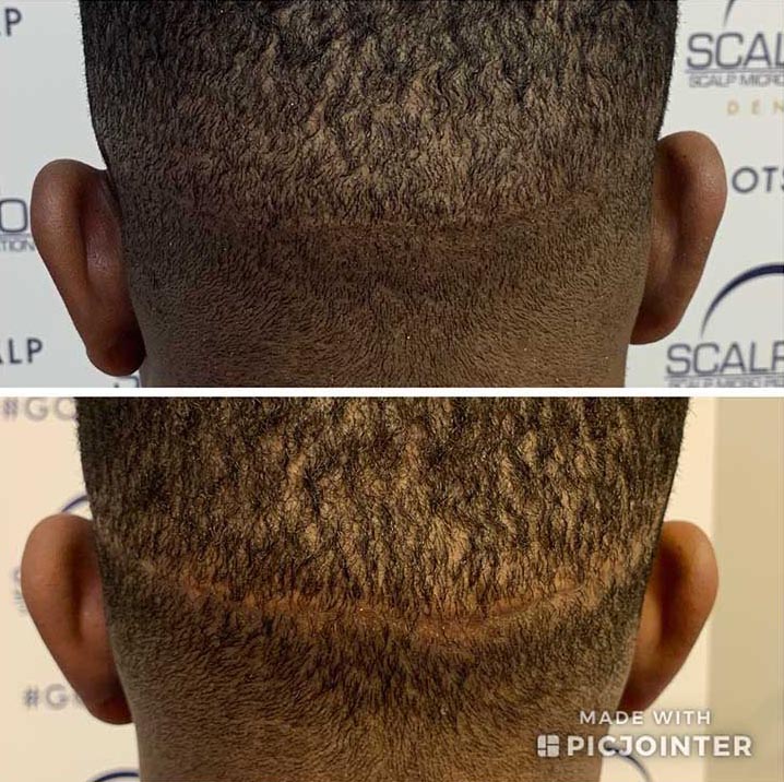 What Is Scalp Micropigmentation?