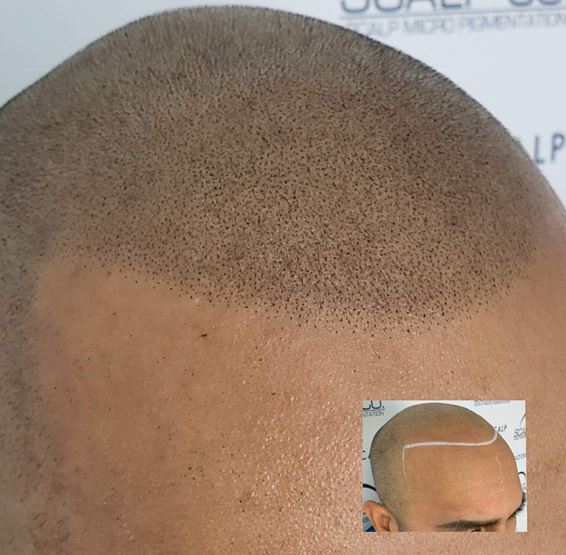 scalp pigmentation