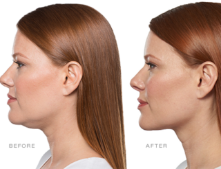Kybella: The First & Only Injectable Chin Treatment