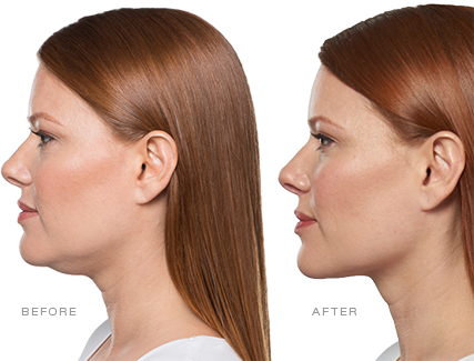 Kybella: The First & Only Injectable Chin Treatment