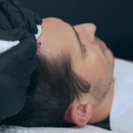 Scalp Micropigmentation