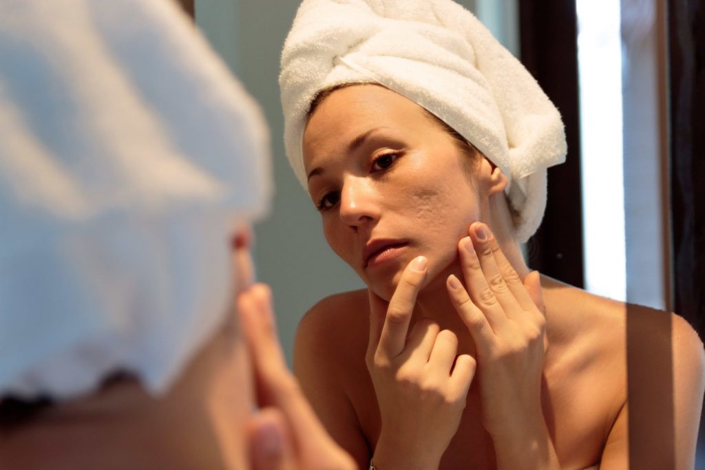 Acne Scarring
