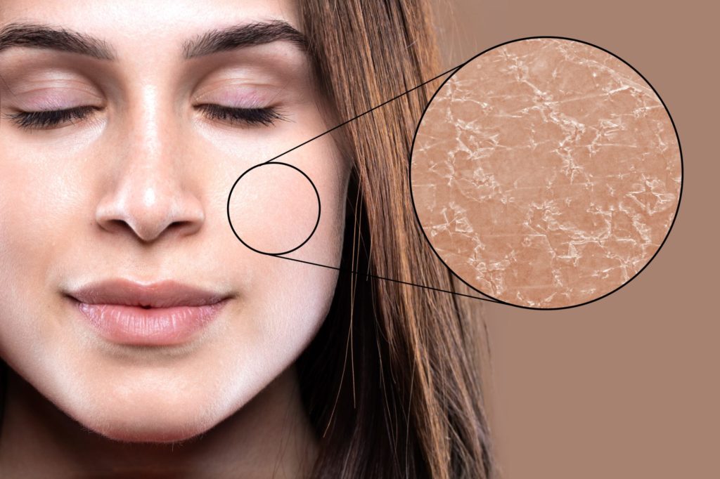 Dehydrated Skin