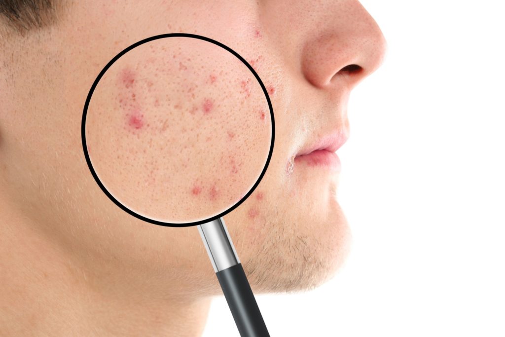 Enlarged Pores