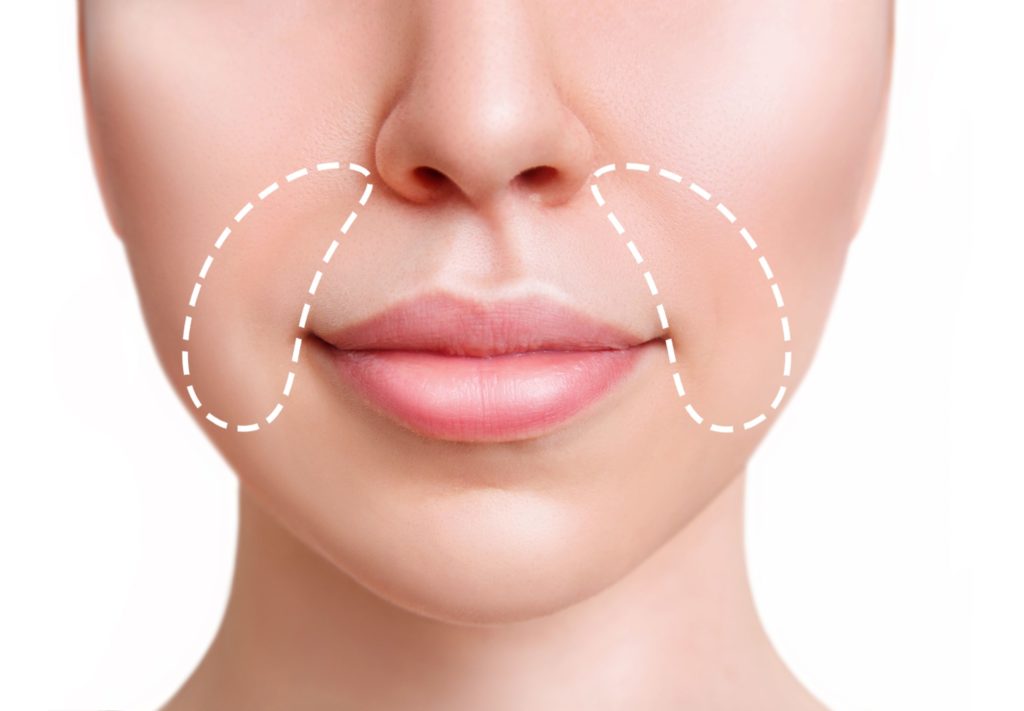 Nasolabial Fold | Laguna Med Spa