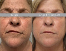 face contouring ba