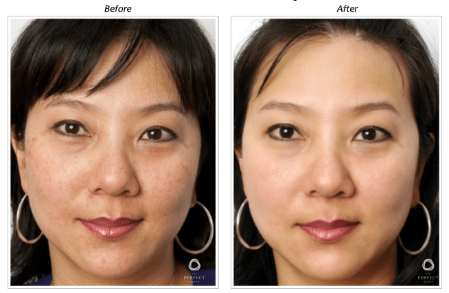 The Perfect Derma Peel. Parker, CO