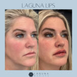 lip filler before and after - Laguna Med Spa Parker, CO​