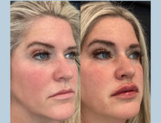 lip filler before and after - Laguna Med Spa Parker, CO​