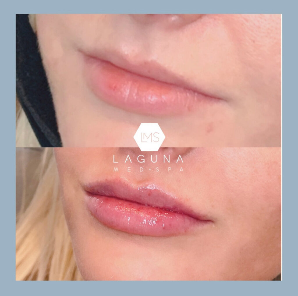 After lip fillers - Parker CO | Laguna Med Spa