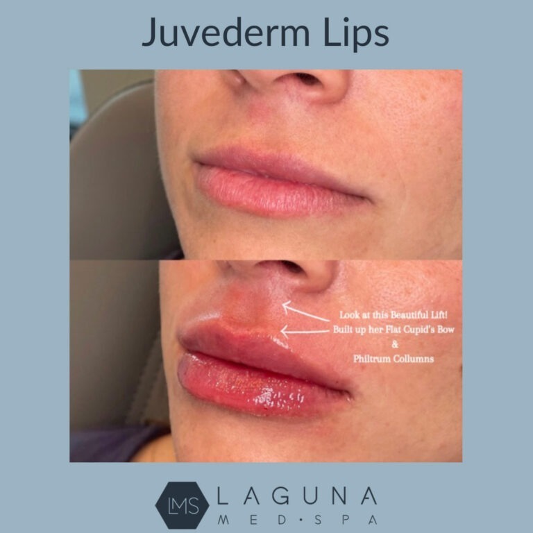 before and after lip filler in Parker CO - Laguna Med Spa