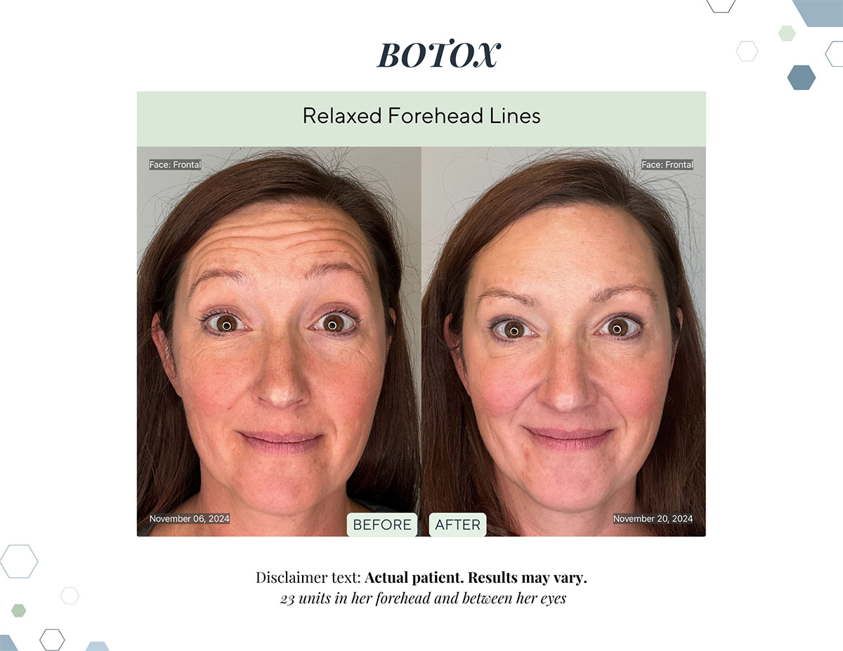 Botox before and after relaxed forehead lines at Laguna Med Spa in Parker, CO