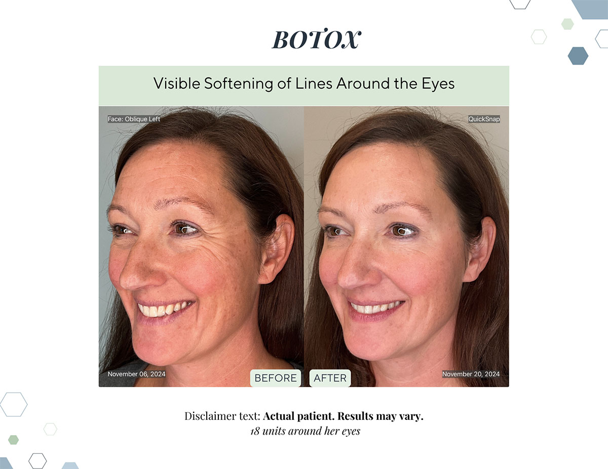 Botox before and after softened lines around the eyes at Laguna Med Spa in Parker, CO