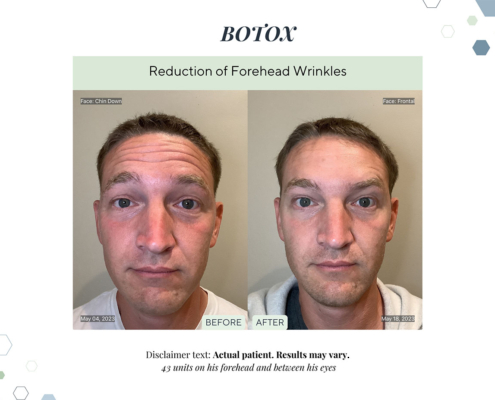 Before and After - In progress - 14