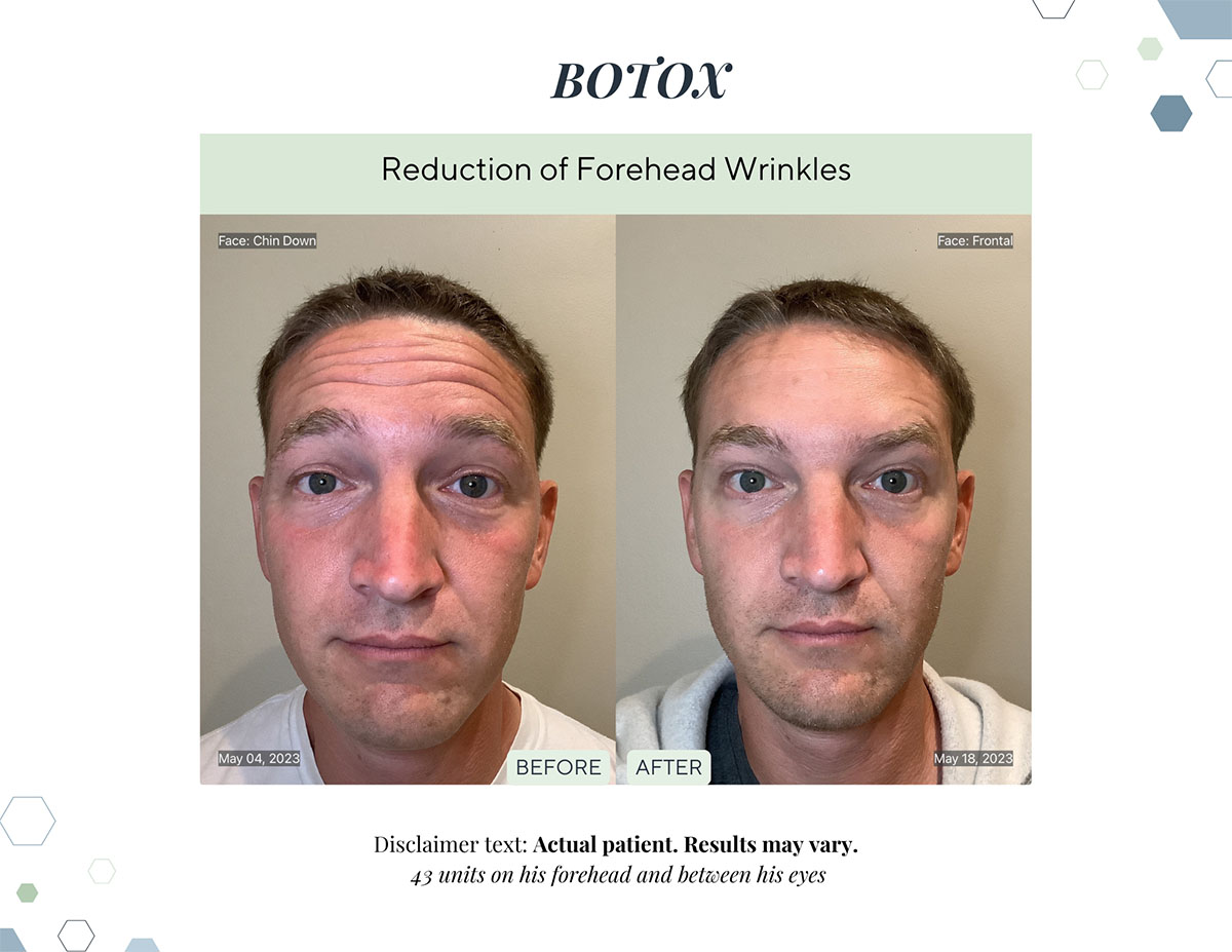 Botox before and after reduced forehead wrinkles at Laguna Med Spa in Parker, CO