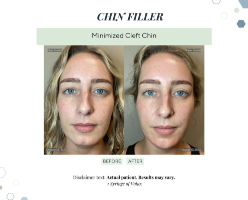 Before and After - In progress - 83