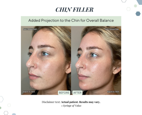 Before and After - In progress - 84