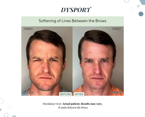 Before and After - In progress - 17