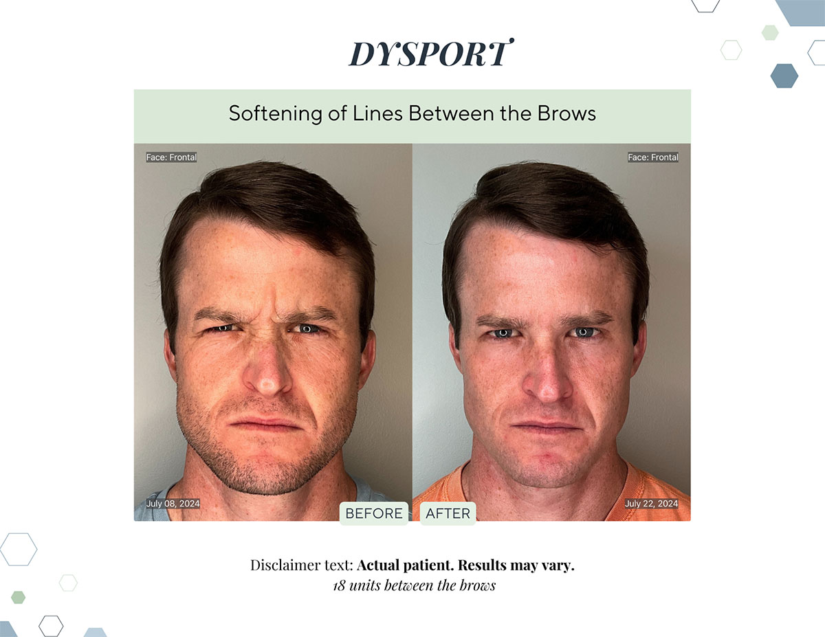 Dysport before and after softened lines between the brows at Laguna Med Spa in Parker, CO