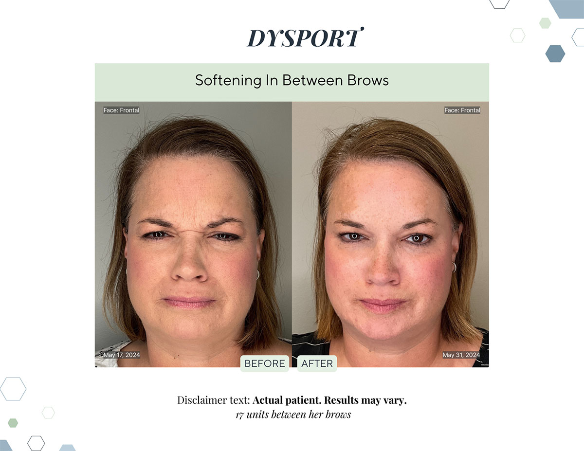 Dysport before and after softened lines between the brows at Laguna Med Spa in Parker, CO