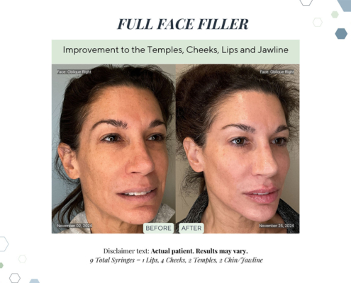 Before and After - In progress - 68