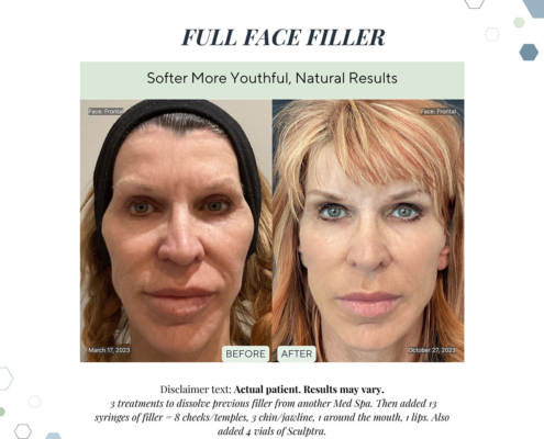 Before and After - In progress - 69