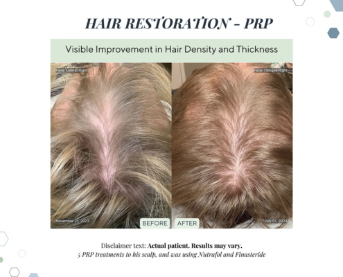 Before and After - In progress - 57 hair restoration before and after