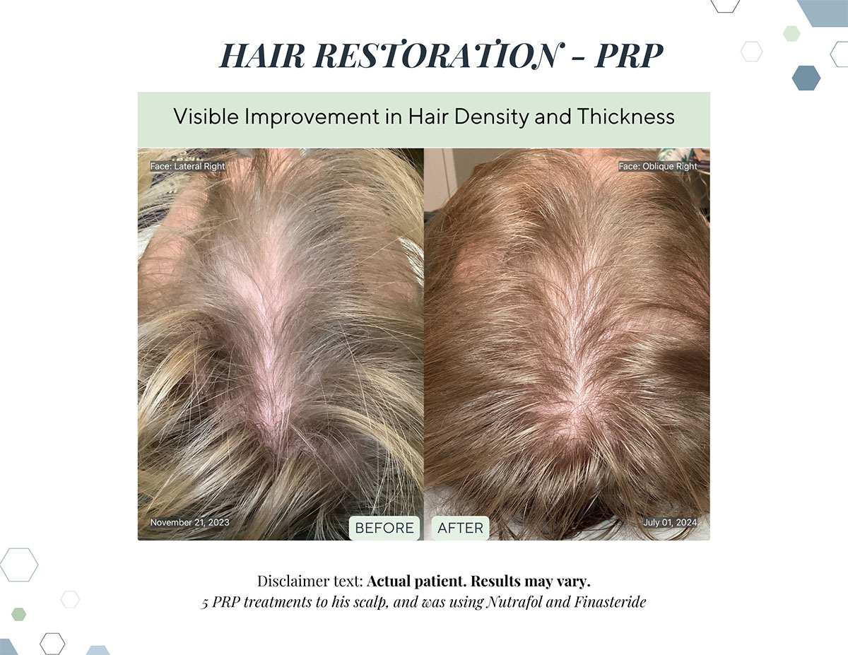 hair restoration before and after