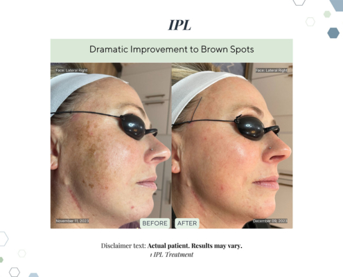 Before and After - In progress - 97