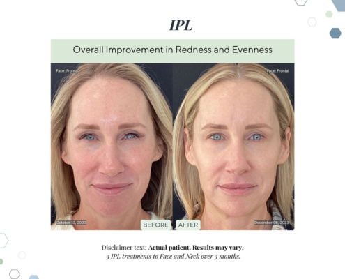 Before and After - In progress - 98