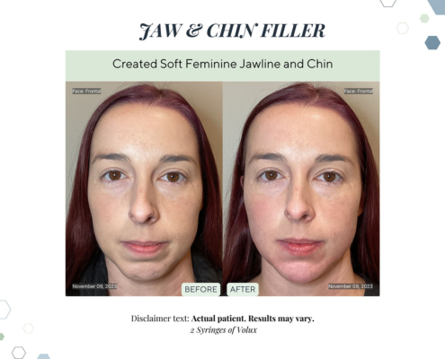 Before and After - In progress - 87