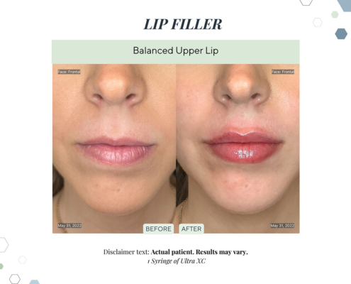 Before and After - In progress - 73