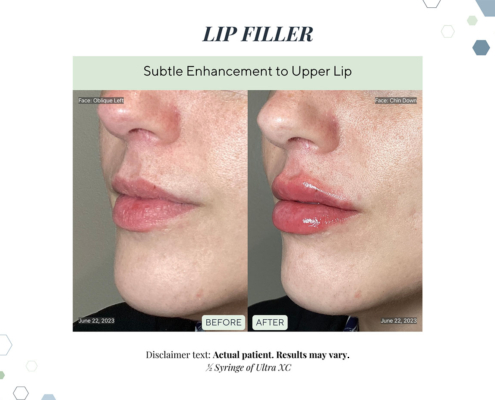 Before and After - In progress - 76