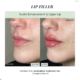 Before and After - lip filler parker co