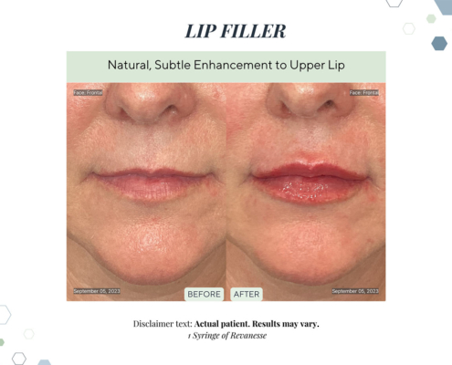 Before and After - In progress - 77