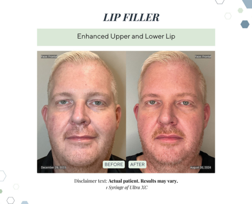 Before and After - In progress - 80