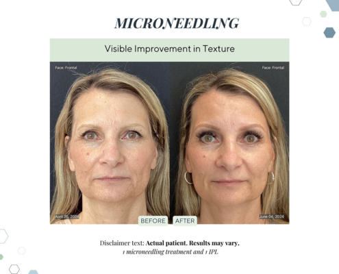 Before and After - In progress - 49