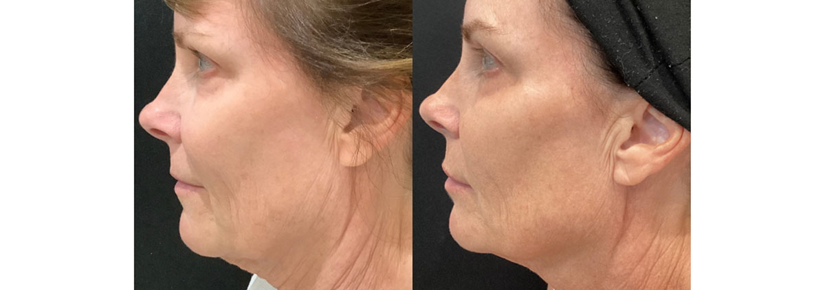 Before and After Morpheus8 mirconeedling