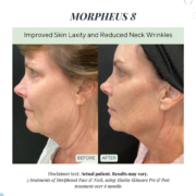 Before and After Morpheus8 mirconeedling