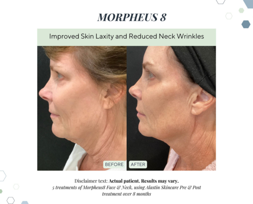 Before and After - In progress - 2