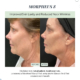 Before and After Morpheus8 mirconeedling
