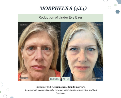 Before and After - In progress - 5