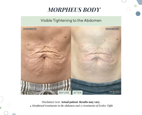 Before and After - In progress - 9