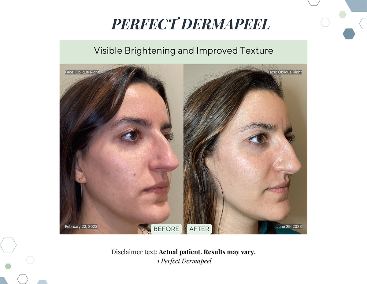 Before and After - derma peel parker co