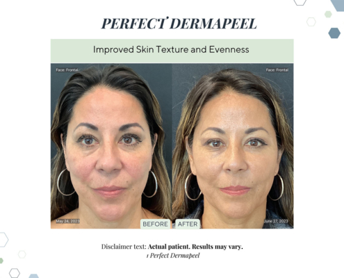 Before and After - In progress - 66