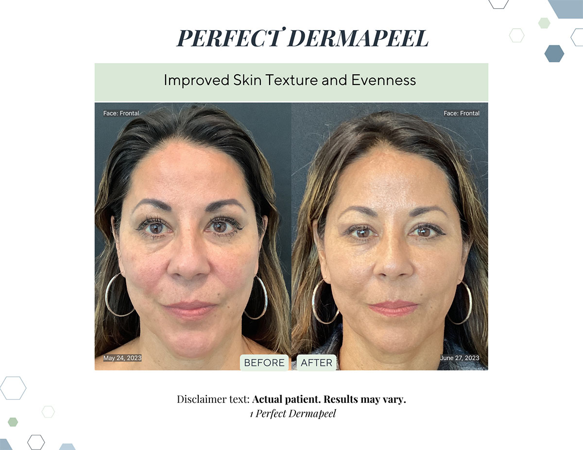 Before and After derma peel